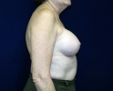 Breast augmentation photos heavy_408.JPG