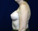 Breast augmentation photos heavy_410.JPG