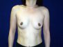 Breast augmentation photos 29*