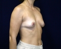 Breast augmentation photos_hi_lo_404.JPG
