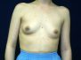 Breast augmentation photos 311*