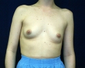 breast_augmentation_photo_spine_506.JPG
