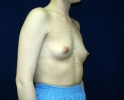 breast_augmentation_photo_spine_507.JPG