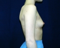 breast_augmentation_photo_spine_508.JPG