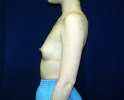breast_augmentation_photo_spine_509.JPG
