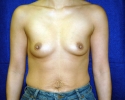 Breast implant pictures_3316.JPG