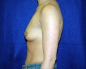 Breast implant pictures_3317.JPG