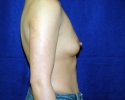 Breast implant pictures_3319.JPG