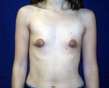 Breast implant pictures dev_106.JPG