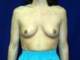Breast augmentation photos 38*