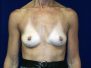 Breast augmentation 387*