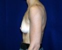 breast_augmentation_photo_308.JPG