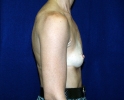 breast_augmentation_photo_310.JPG