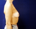 breast_augmentation_photo_heavy_203.JPG