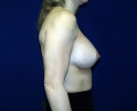 breast_augmentation_photo_hi_lo_203.JPG