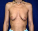 before-breast-implant-42.JPG