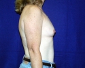 breast_augmentation_photo_hi_lo_902.jpg