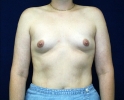 breast_augmentation_photo_upf_501.JPG