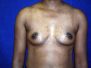 Breast augmentation photos 537*