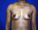 Breast-augmentation-before-537.JPG