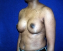 breast-implant-photo-after-537.JPG