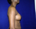 side-view-breast-augmentation-after-537