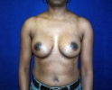 breast-augmentation-after-537.JPG