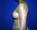 side-photo-after-breast-augmentation-537.JPG