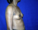 side-view-breast-augmentation-before-537.JPG