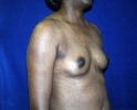 angled-view-breast-implant-photo-537.JPG