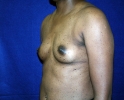 breast-implant-photo-before-537.JPG