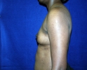 side-photo-before-breast-augmentation-537.JPG