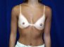 Breast augmentation pictures 549*
