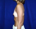 breast_augmentation_photo_204.JPG