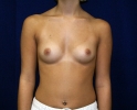 breast_implant_photo_lpfo2_406.JPG