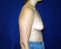 breast_augmentation_photo_hi_lo_502.JPG