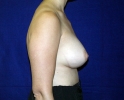 breast_augmentation_photo_hi_lo_506.JPG
