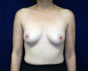 breast_augmentation_photo_1901.JPG