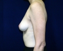 breast_augmentation_photo_1902.JPG