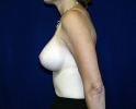 breast_augmentation_photo_1910.JPG