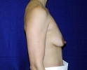 side-view-photo-breast-implants-57.JPG