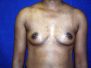 Breast augmentation pictures 587*