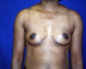 breast_augmentation_photo_2501.JPG