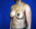 breast_augmentation_photo_2502.JPG