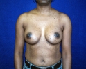 breast_augmentation_photo_2505.JPG