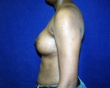 breast_augmentation_photo_2506.JPG