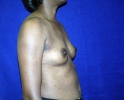breast_augmentation_photo_2507.JPG