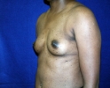 breast_augmentation_photo_2510.JPG