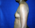 breast_augmentation_photo_2511.JPG
