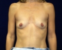 Breast augmentation photos gap_306.JPG